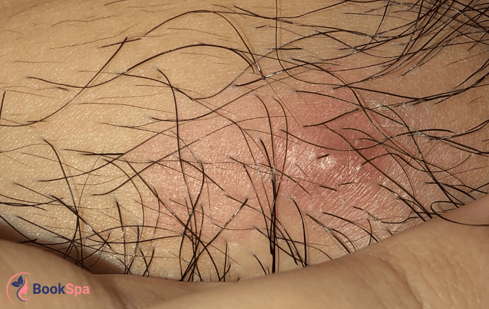 Nguyên nhân mọc mụn vùng kín, phân loại và cách xử lý nhanh