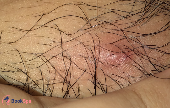 Nguyên nhân mọc mụn vùng kín luôn là mối quan tâm lớn của cả nam và nữ